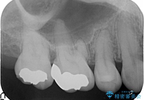 むし歯の治療。ゴールドインレーによる修復の治療後