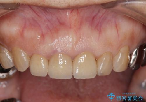 前歯の審美改善の治療後