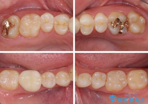 気になる前歯を審美歯科治療と矯正歯科治療で美しくの治療後