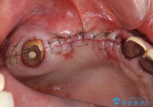 他院で中途半端に終わってしまったインプラント治療 の治療中