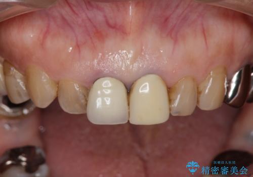 前歯の審美改善の治療前