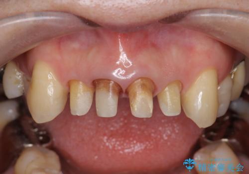 歯茎の黒ずみがきになる　前歯の見た目を改善したいの治療中