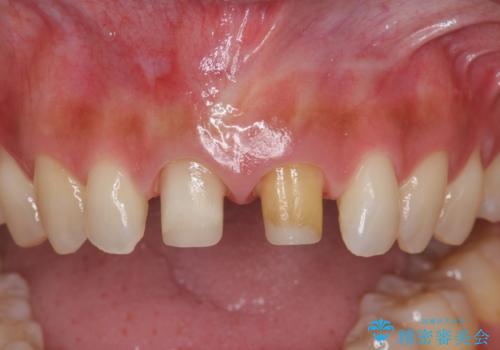 短期集中  前歯審美治療の治療中