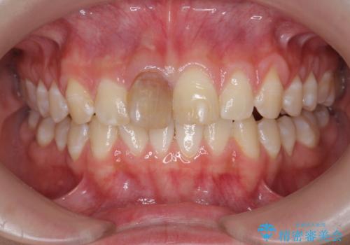 前歯をきれいにしたい ジルコニアクラウンによる審美治療の治療前