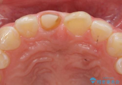 前歯をきれいにしたい ジルコニアクラウンによる審美治療の治療中