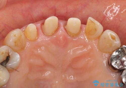 前歯の審美改善の治療中