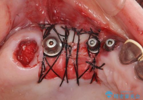 他院で中途半端に終わってしまったインプラント治療 の治療中