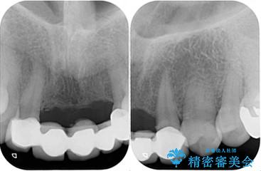 古くなった前歯のブリッジをオールセラミックにの治療前
