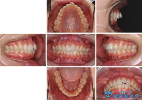 口が閉じにくい 1本飛び出した前歯の矯正治療の治療前