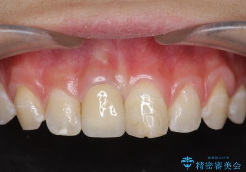 前歯をきれいにしたい ジルコニアクラウンによる審美治療の症例 治療後