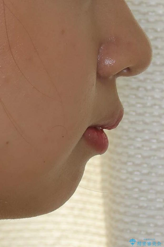 抜歯矯正で口元に変化を ラビアル・ワイヤー矯正でEラインの治療前(顔貌)
