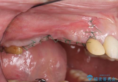 他院で中途半端に終わってしまったインプラント治療 の治療前