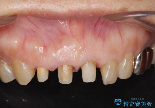 前歯の審美改善の治療中