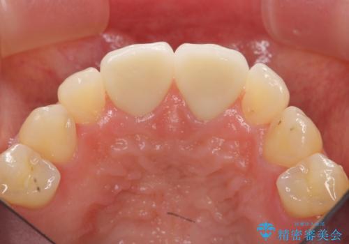 短期集中  前歯審美治療の治療後