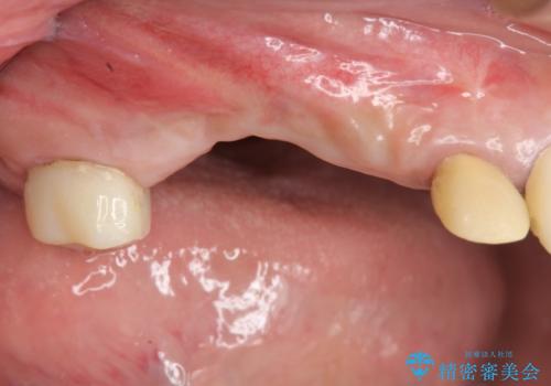 他院で中途半端に終わってしまったインプラント治療 の治療前
