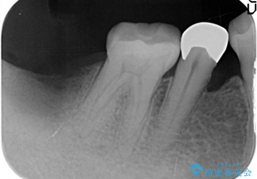 奥歯が痛い。骨増生を併用したインプラントの治療後