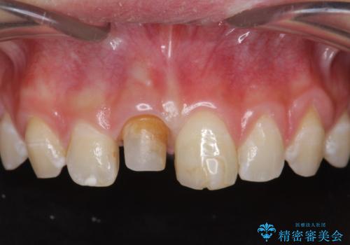 前歯をきれいにしたい ジルコニアクラウンによる審美治療の治療中