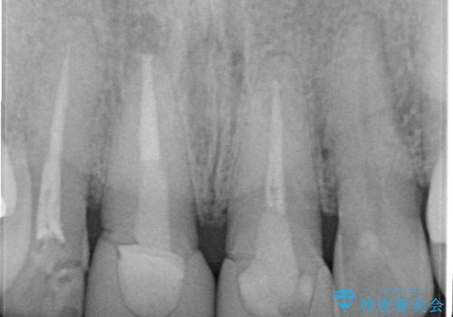 差し歯(被せ物)のやりかえ 上の前歯で印象が明るくの治療後