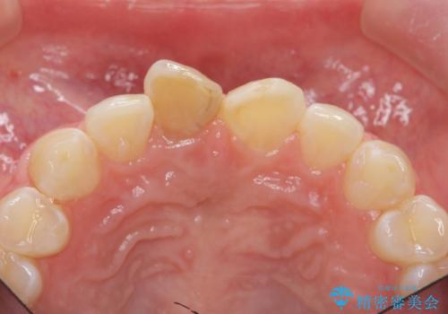 前歯をきれいにしたい ジルコニアクラウンによる審美治療の治療前