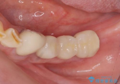 歯を失い噛めない、インプラントによる咬合機能回復の治療後