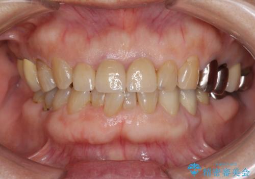 前歯の審美改善の治療後