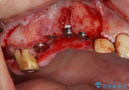 他院で中途半端に終わってしまったインプラント治療 の治療後