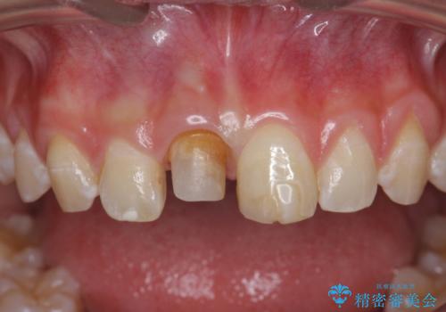 前歯をきれいにしたい ジルコニアクラウンによる審美治療の治療中