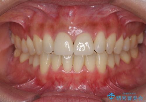 短期集中  前歯審美治療の治療後