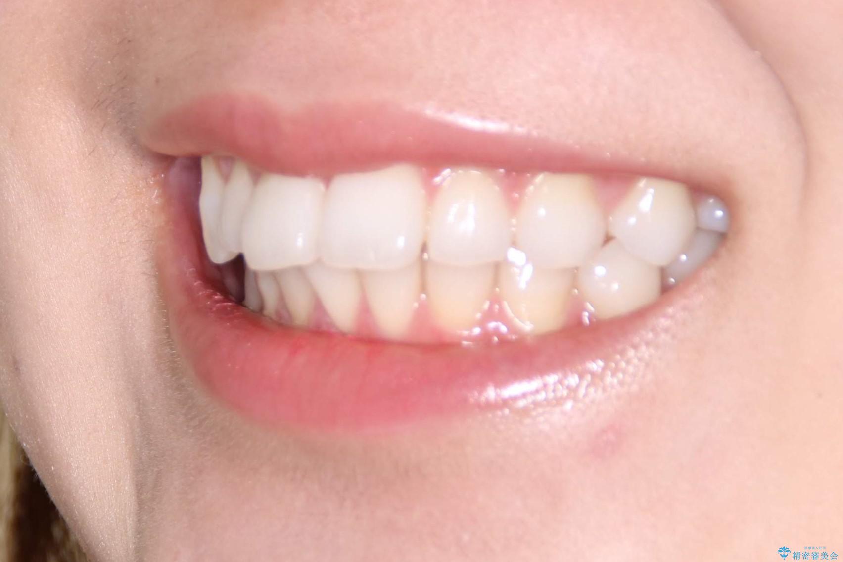 インビザラインで出っ歯を改善する　抜歯をしないinvisalign治療の治療前（顔貌）