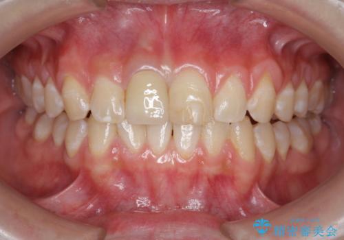 前歯をきれいにしたい ジルコニアクラウンによる審美治療の治療後