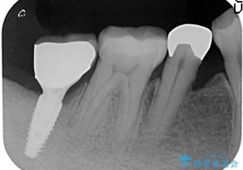 奥歯が痛い。骨増生を併用したインプラントの治療後