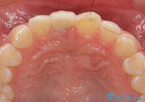 前歯をきれいにしたい ジルコニアクラウンによる審美治療の治療後