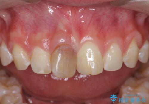 前歯をきれいにしたい ジルコニアクラウンによる審美治療の治療前