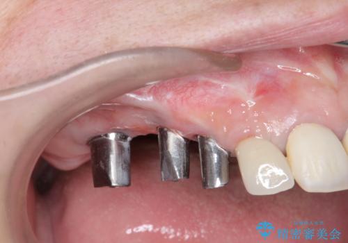 他院で中途半端に終わってしまったインプラント治療 の治療中