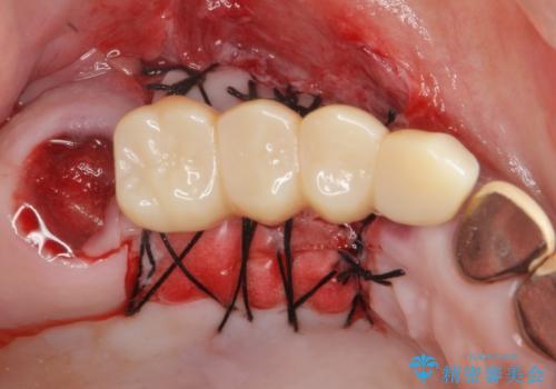 他院で中途半端に終わってしまったインプラント治療 の治療後