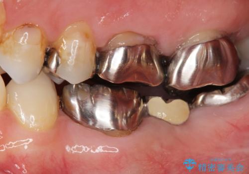 最後方臼歯のインプラント補綴の治療前