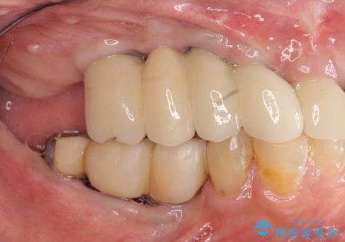 他院で中途半端に終わってしまったインプラント治療 の治療後