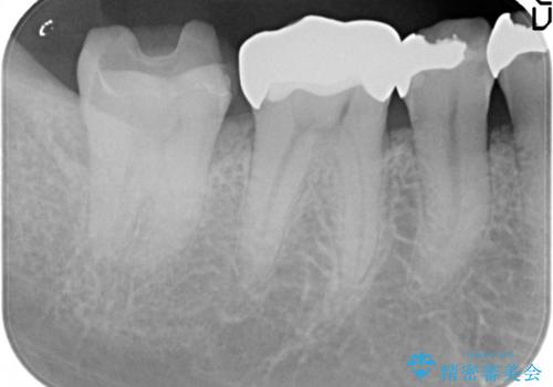 セラミッククラウンによるむし歯治療の治療前