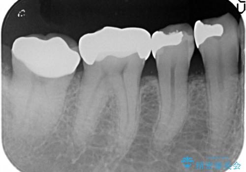 セラミッククラウンによるむし歯治療の治療後
