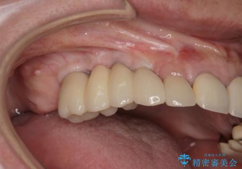 他院で中途半端に終わってしまったインプラント治療 の治療後