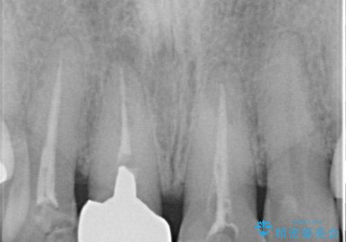 差し歯(被せ物)のやりかえ 上の前歯で印象が明るくの治療前