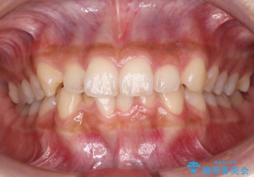 犬歯のねじれ　下の歯のがたがた　インビザラインでの治療前