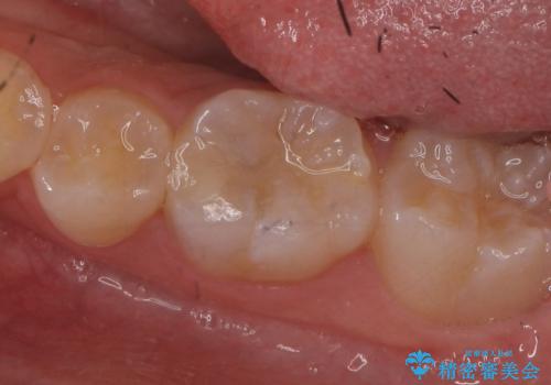 セラミックインレー しみる歯の治療の治療前
