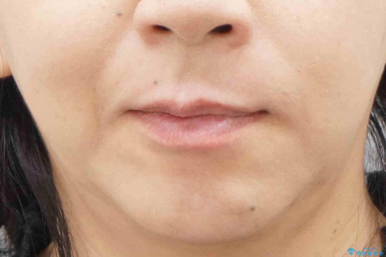 40代女性 前歯の重なり あきらめずに矯正の治療後(顔貌)