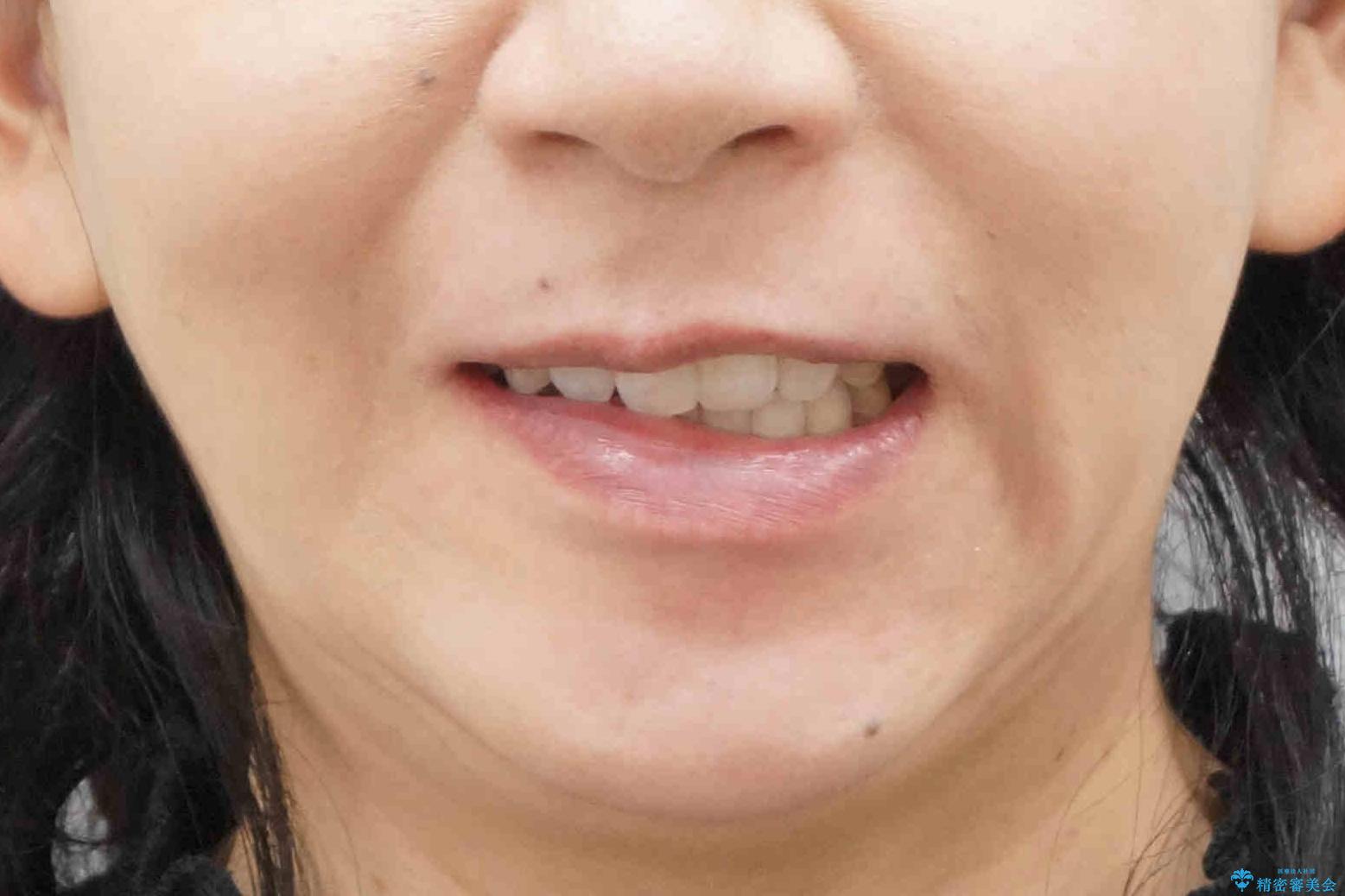 40代女性　前歯の重なり　あきらめずに矯正の治療後（顔貌）