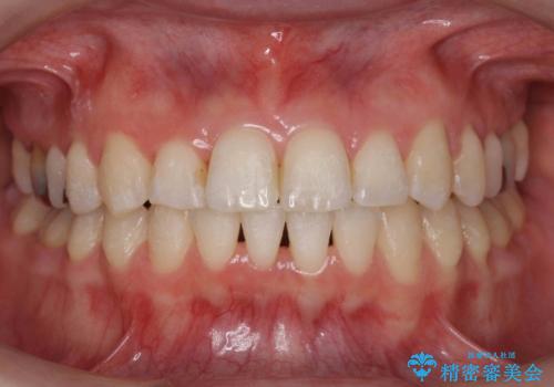 抜かない、削らない矯正 大人も上顎を骨から広げますの症例 治療後