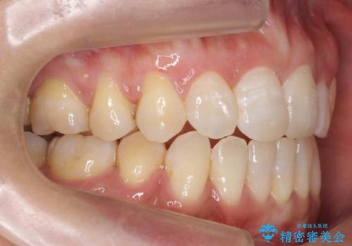 40代女性 前歯の重なり あきらめずに矯正の治療後