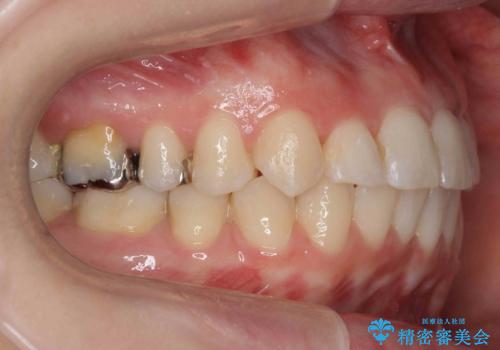 抜かない、削らない矯正 大人も上顎を骨から広げますの治療後