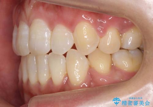 40代女性　前歯の重なり　あきらめずに矯正の治療後