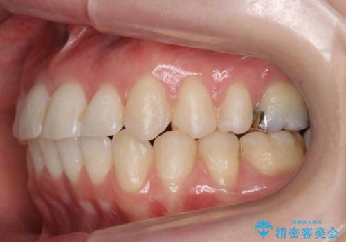 抜かない、削らない矯正 大人も上顎を骨から広げますの治療後
